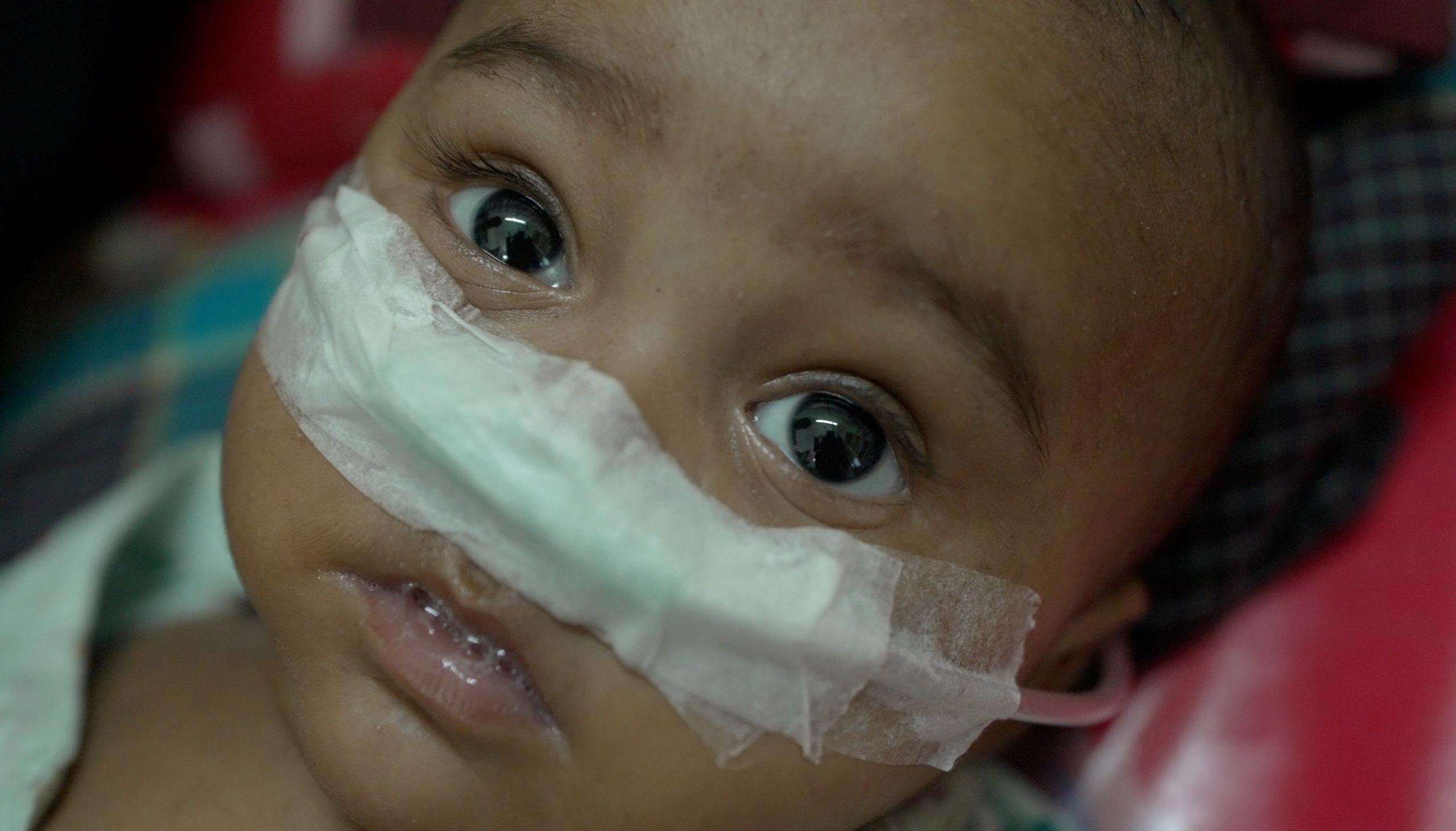 Children keep dying in a country that made huge progress on measles