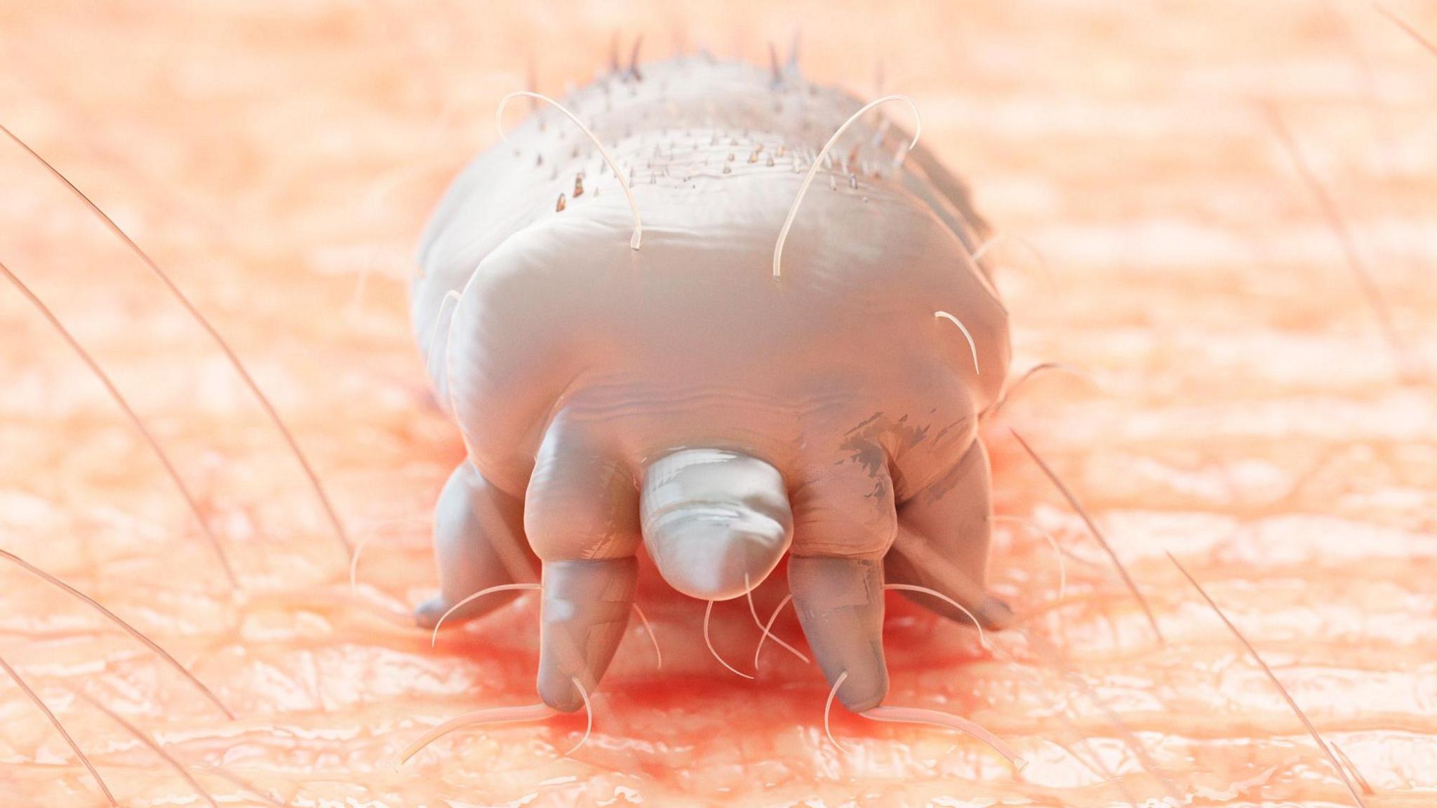 Rare crusted scabies outbreak shuts hospital ward