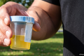 Urine test can spot more than nine in 10 bladder cancers